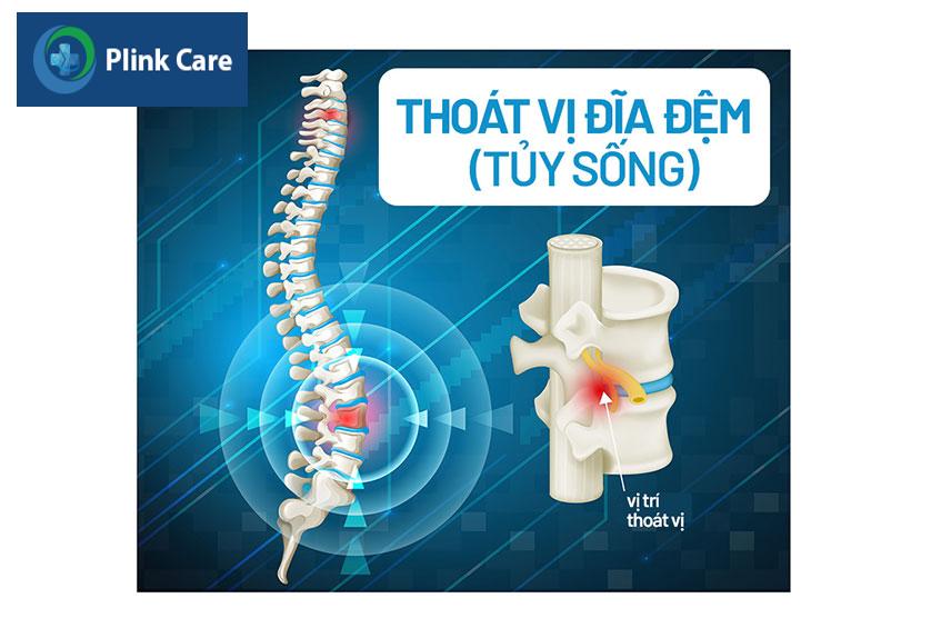 Vị trí thoát vị đĩa đệm