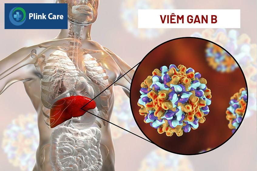 bệnh viêm gan siêu vi b