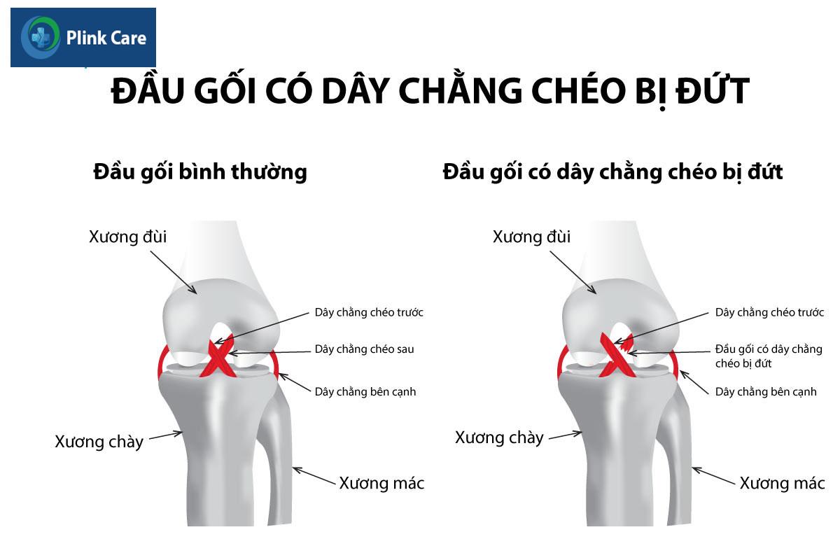 dut-day-chang-cheo-sau-infographic