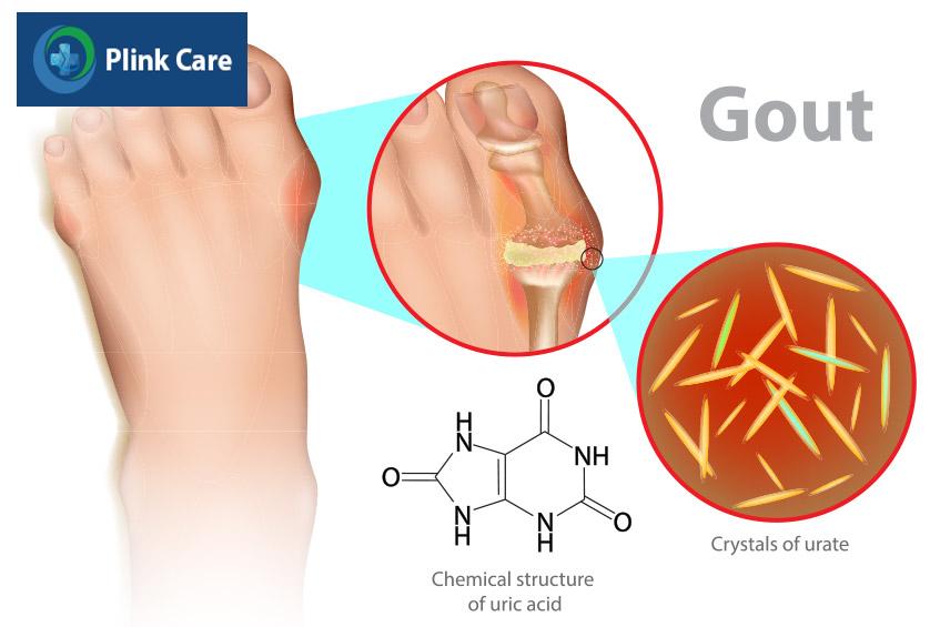 giai đoạn 4 của bệnh gút