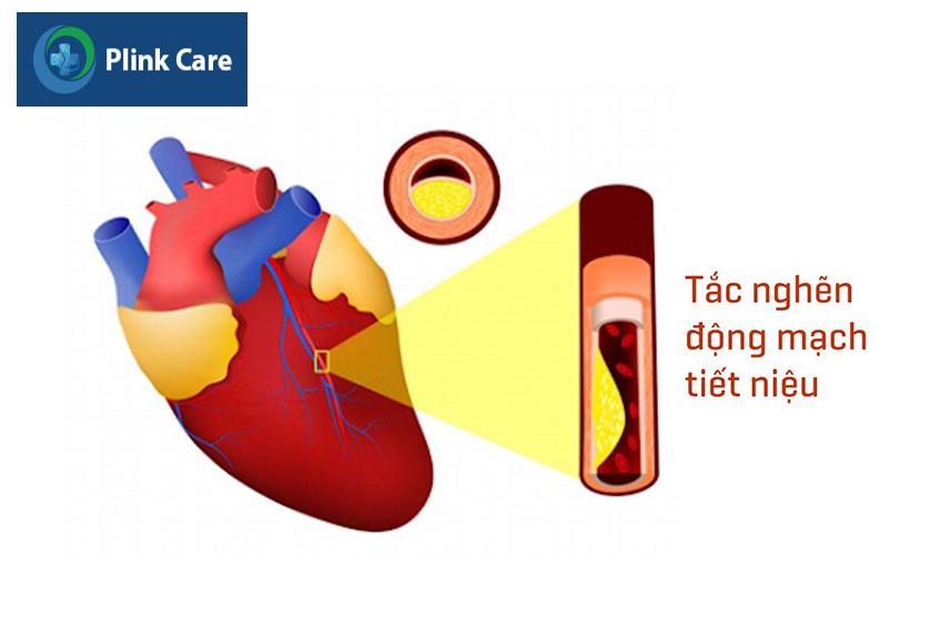Nhồi máu cơ tim cấp