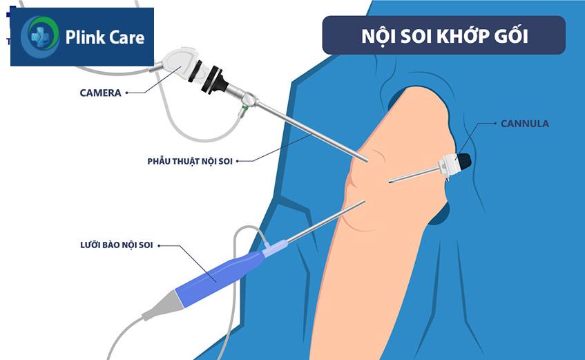 noi-soi-khop-goi
