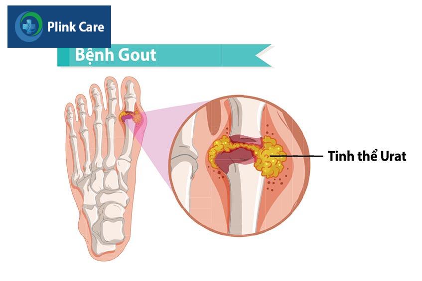 bệnh gút là gì