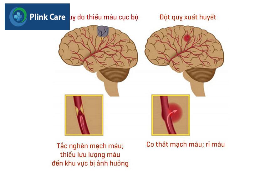 Đột quỵ bao gồm xuất huyết não (Haemorrhagic stroke) và nhồi máu não (Ischemic stroke)