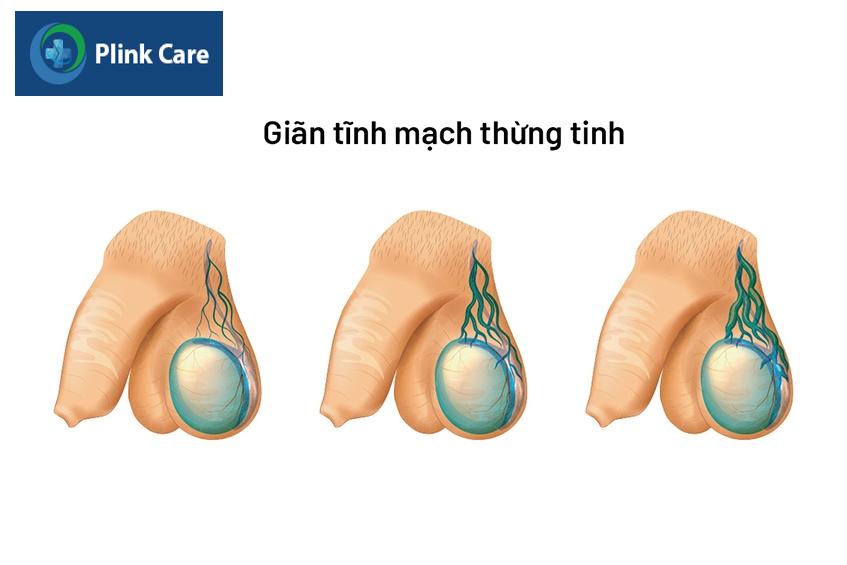 chẩn đoán giãn tĩnh mạch thừng tinh