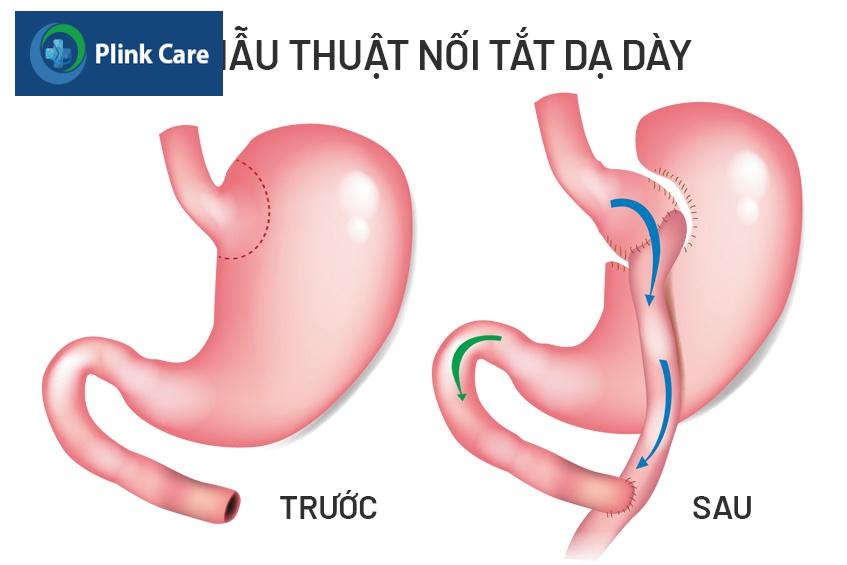 phẫu thuật nội tắt dạ dày