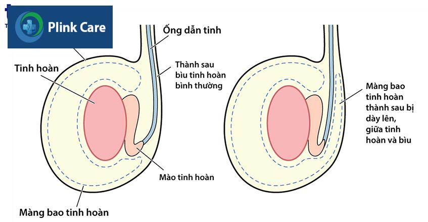 tắc ống dẫn tinh
