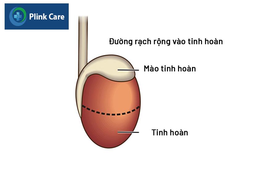 minh họa đường rạch rộng vào tinh hoàn