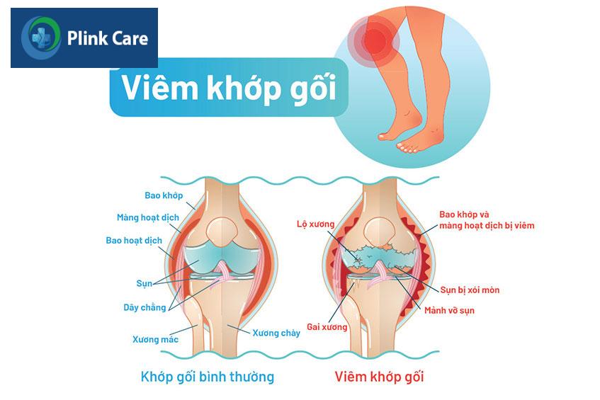 tình trạng viêm khớp gối là gì
