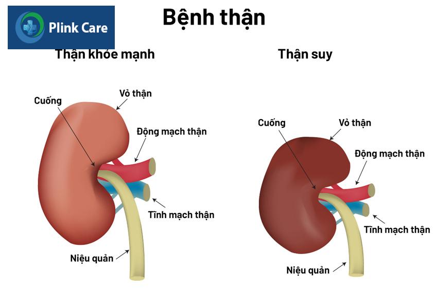 suy thận là bệnh gì