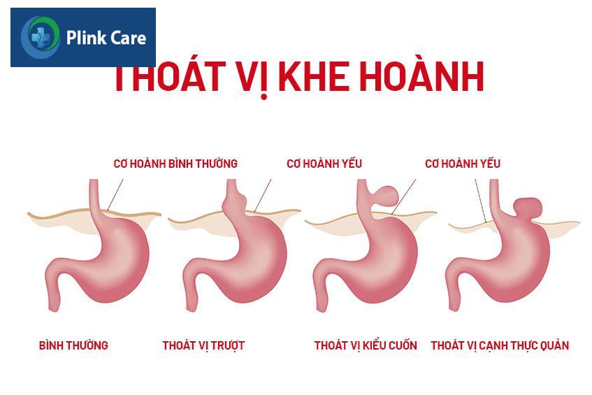 Các dạng thoát vị khe hoành