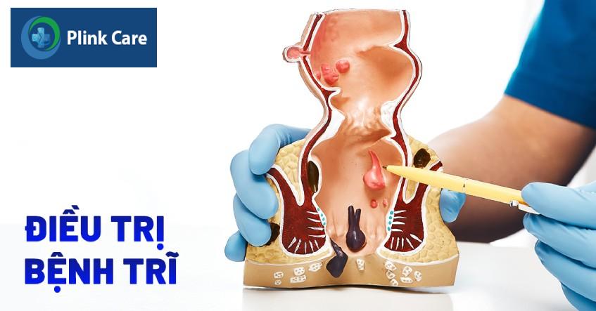 điều trị bệnh trĩ