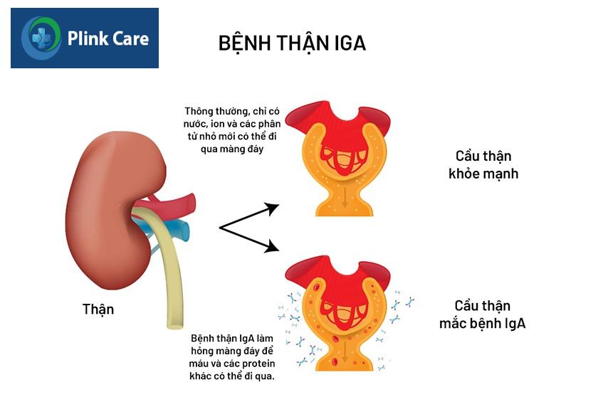 minh họa bệnh thận iga