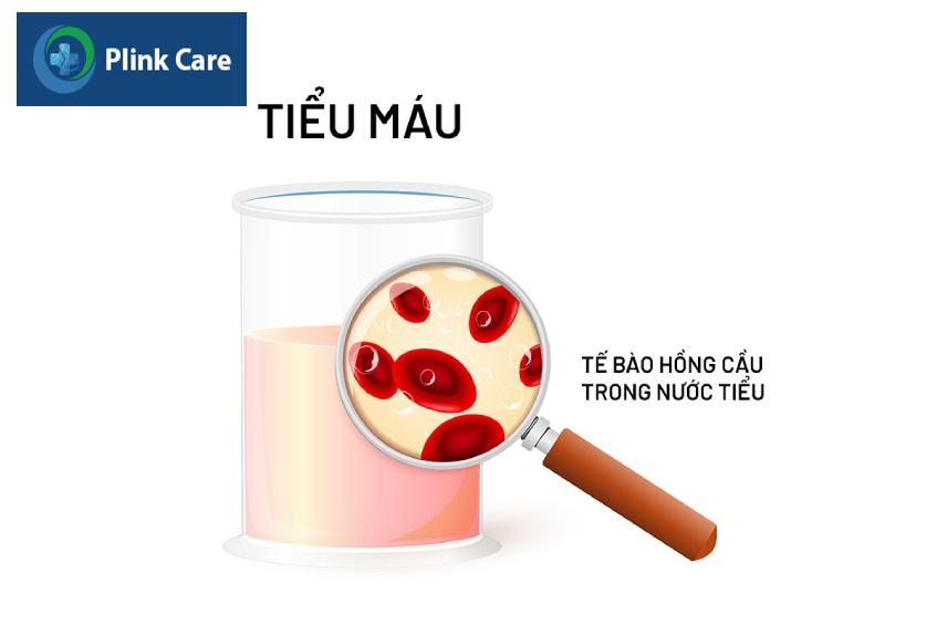 nguyên nhân gây bệnh cầu thận