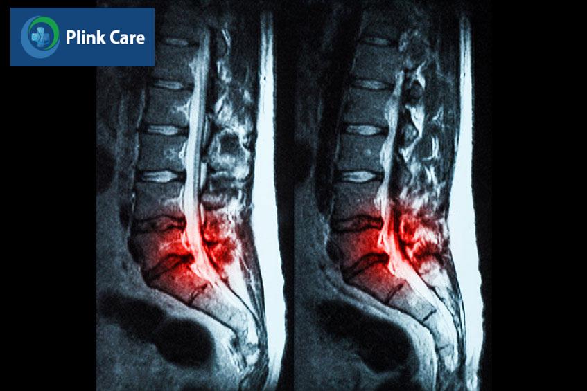 thoát vị đĩa đệm cột sống lưng l4l5 l5s1