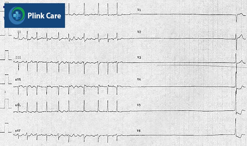 ecg hội chứng nhịp nhanh nhịp chậm