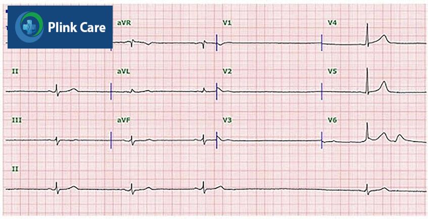 ECG hội chứng suy nút xoang