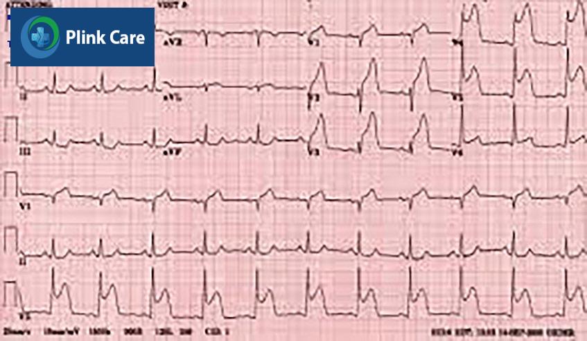 Nhồi máu cơ tim ST chênh lên (STEMI)