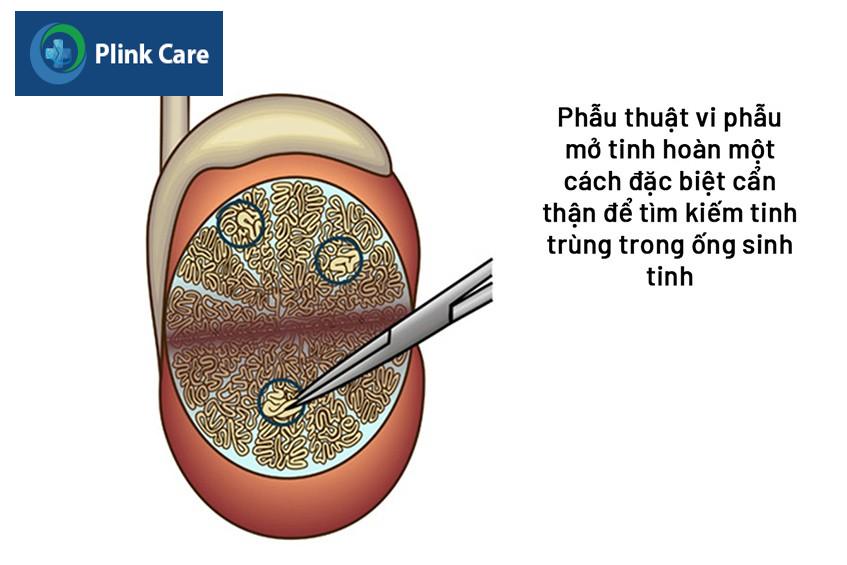minh họa microdissection tese