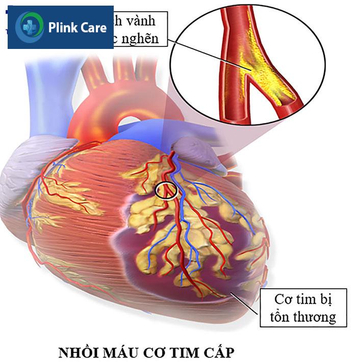 Hình ảnh minh họa nhồi máu cơ tim
