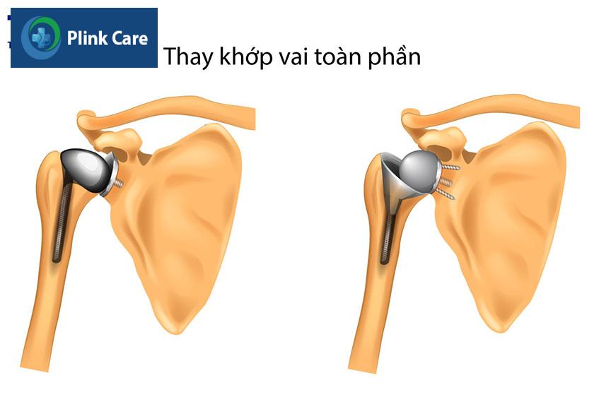 phẫu thuật thay khớp vai toàn phần