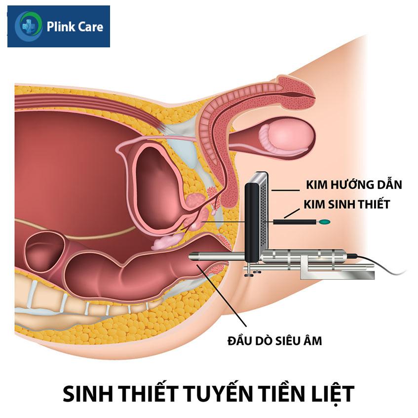 Sinh thiết điều trị phì đại tuyết tiền liệt