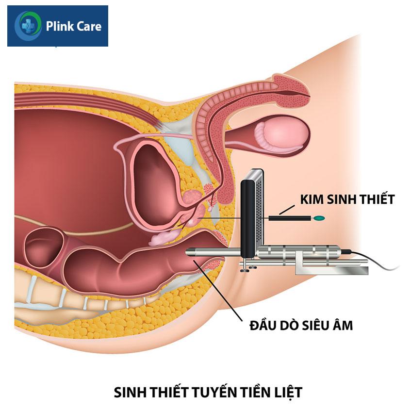 sinh thiết tuyến tiền liệt