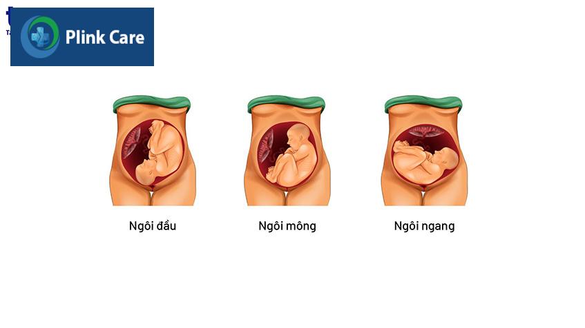 ngôi thai bất thường