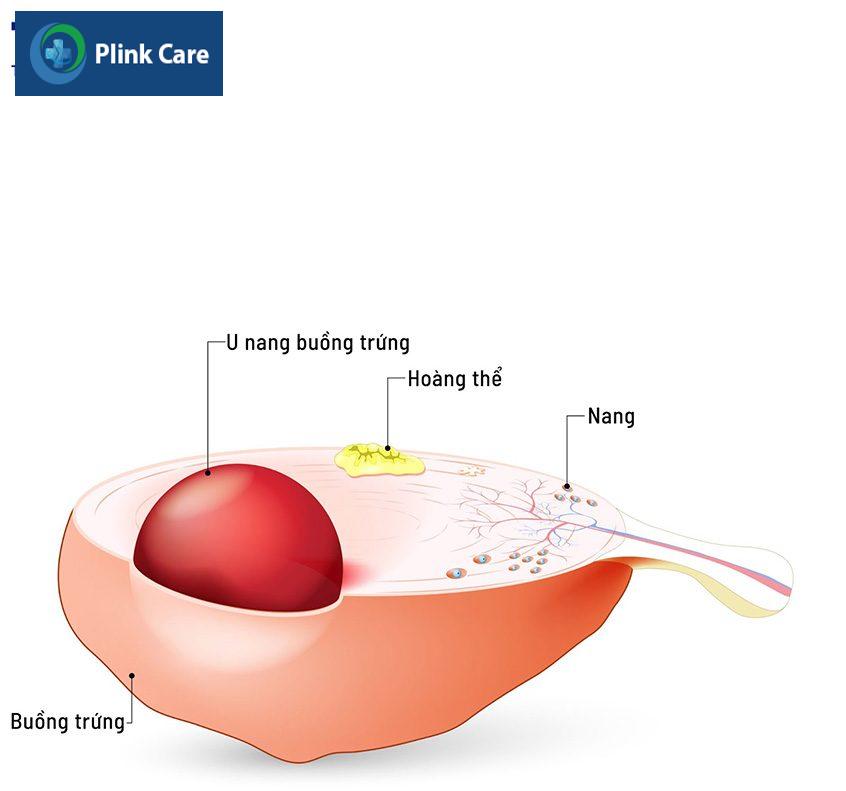 phẫu thuật u nang buồng trứng là gì