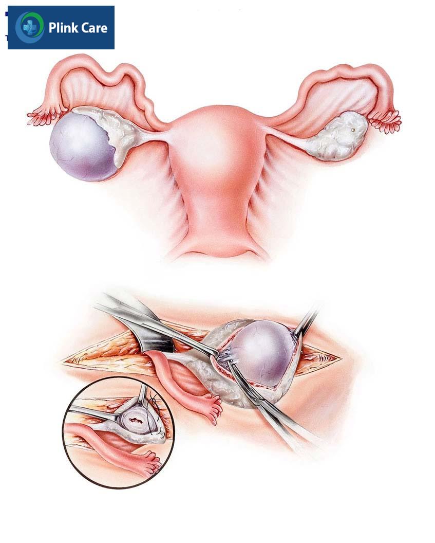 phương pháp phẫu thuật