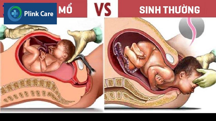so sánh sinh thường và sinh mổ