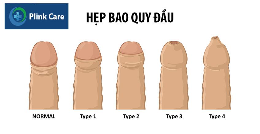 chẩn đoán hẹp bao quy đầu