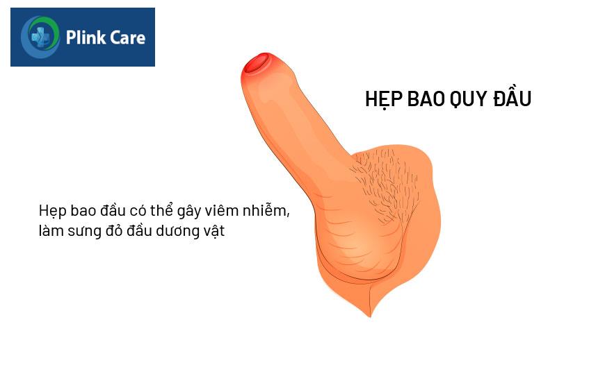 hẹp bao quy đầu ở người lớn như thế nào