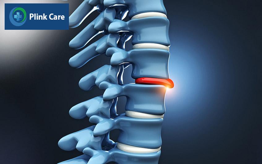 thoát vị đĩa đệm thắt lưng