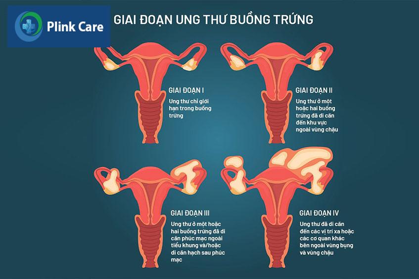 ung thư buồng trứng