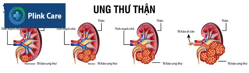 ung thư thận