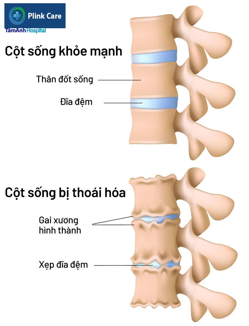 bệnh lý gai cột sống