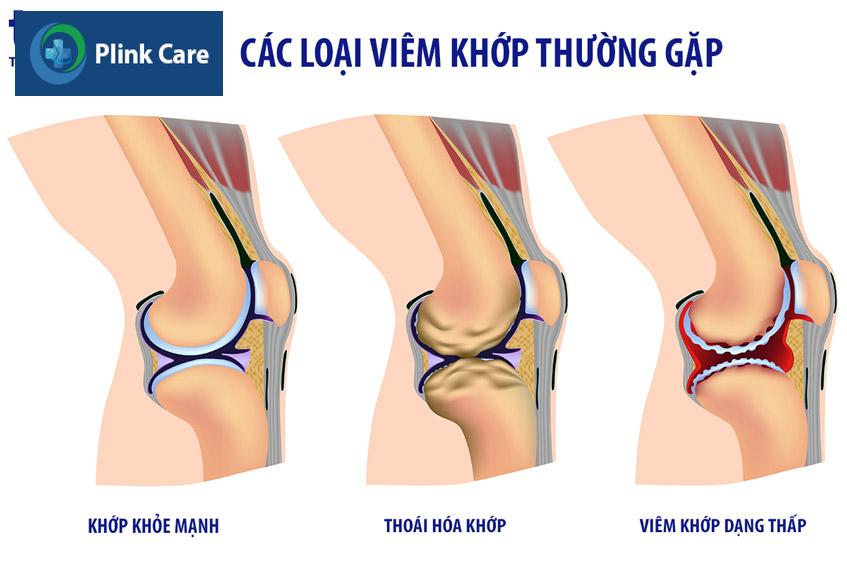 các loại viêm khớp thường gặp