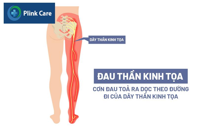 đau lưng lan xuống mông, đùi, bắp chân