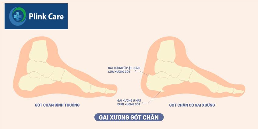 gai xương ở gót chân
