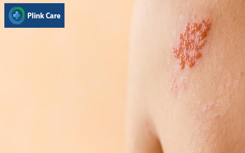 herpes sinh dục