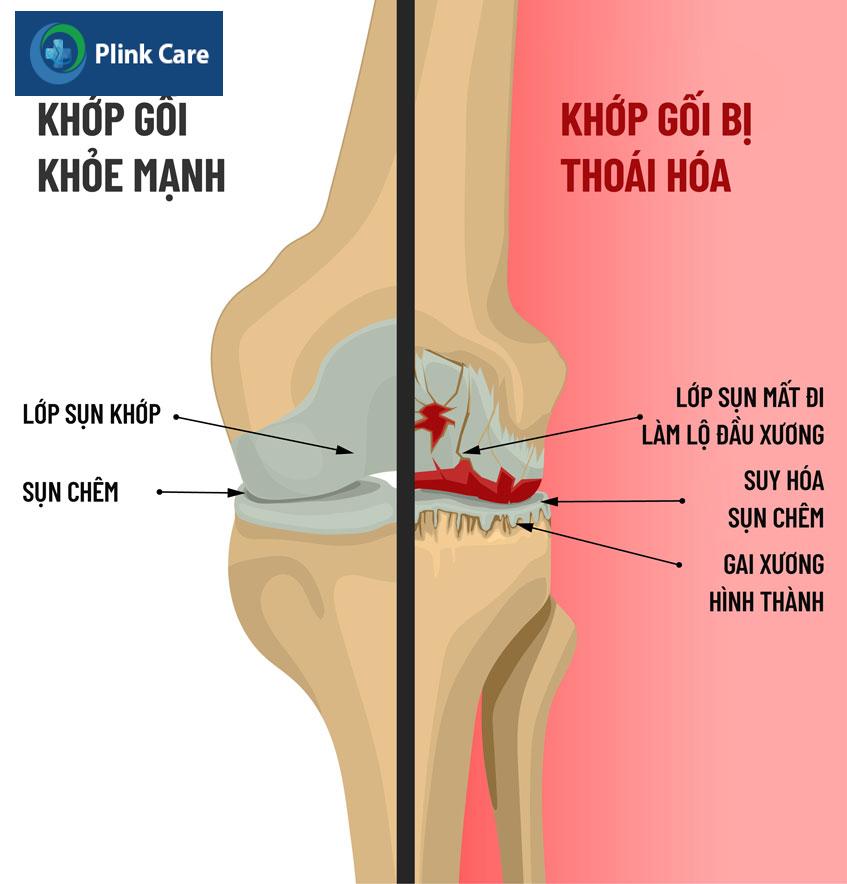 khớp bị thoái hóa