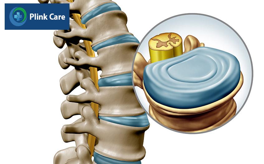 phẫu thuật thay đĩa đệm nhân tạo