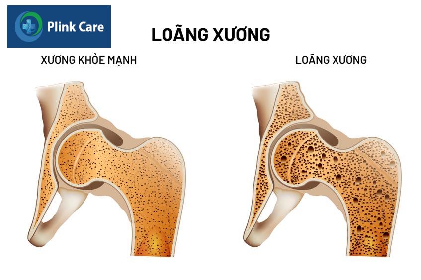 tình trạng xốp xương