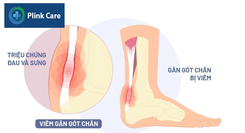 viêm gân achilles