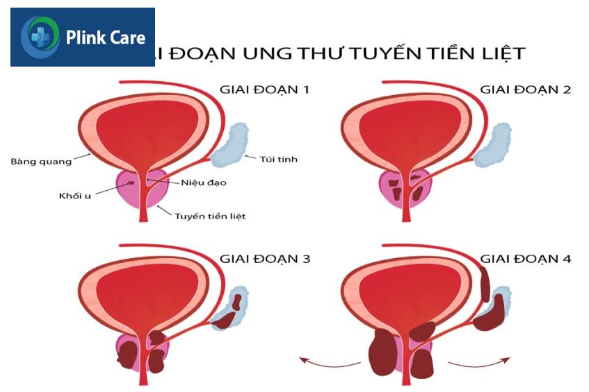 4 giai đoạn ung thư tuyến tiền liệt