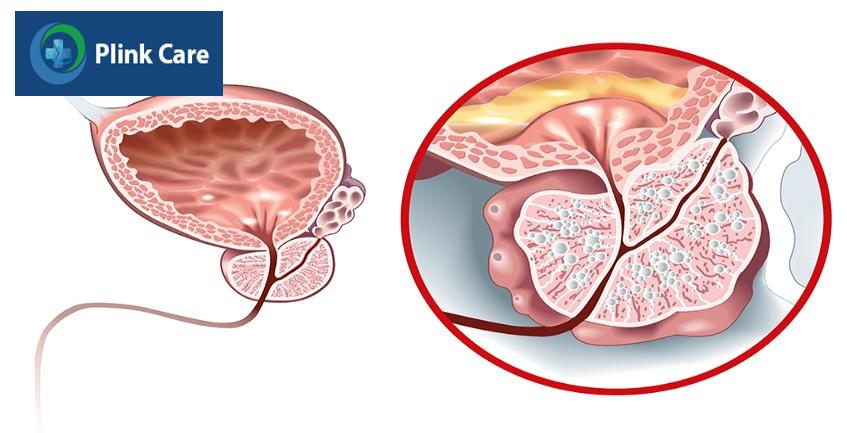 Tăng sinh lành tính tuyến tiền liệt