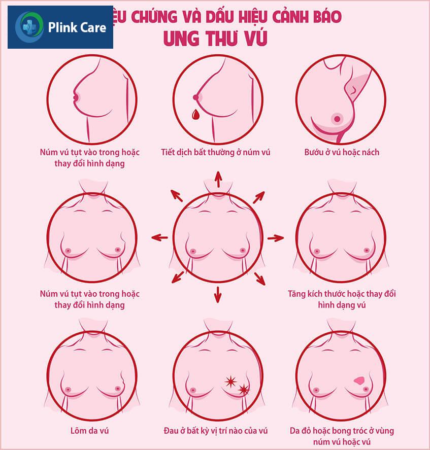 dấu hiệu ung thư vú
