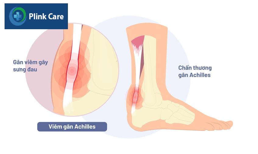 gân achilles bị viêm