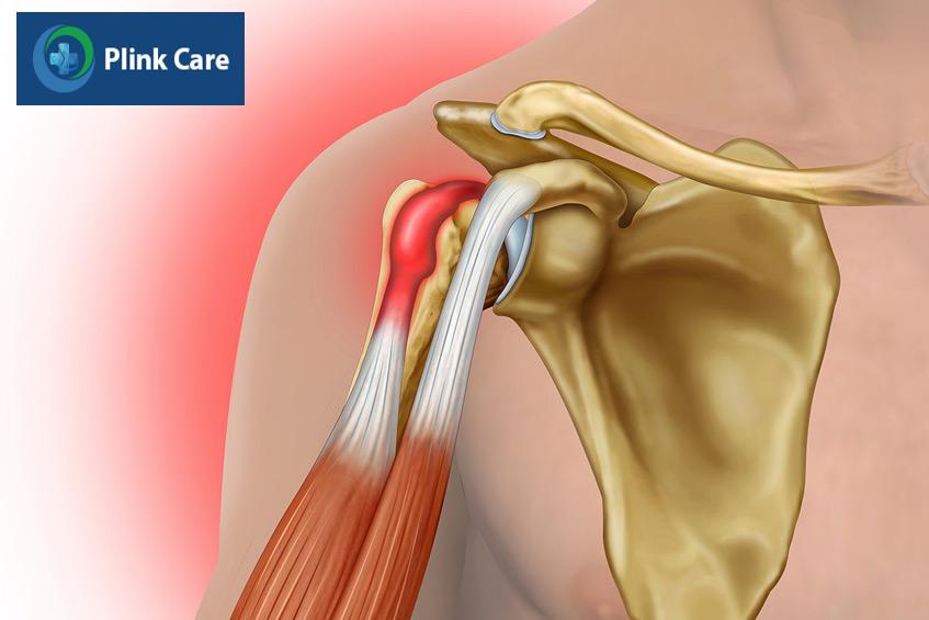 gân dễ bị kích ứng